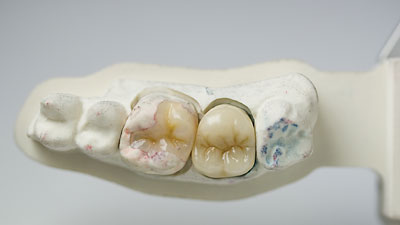 Zahnersatz Zahnarzt Sindelfingen