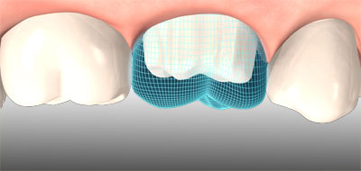 3D-Datenmodell der Zahnsituation