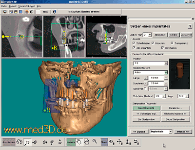 3D-Planung des Implantologen 