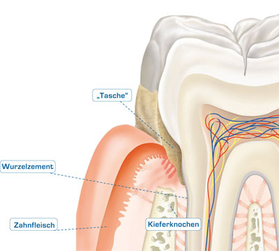 grafische Darstellung der Parodontitistherapie