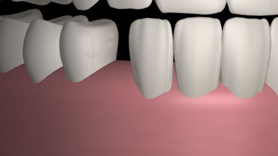 Grafik: Zahnlücke