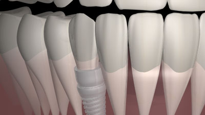 Grafik: Implantat mit Zahnersatz
