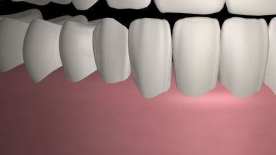 Grafik: Implantat mit Zahnersatz und gesunden Nachbarzähnen